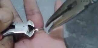 הטבעות נתקעו על האצבע – מתנדבי ידידים הצליחו להסיר שחרור טבעת שנתקעה על אצבע שהתנפחה. צילום באדיבות ארגון ידידים