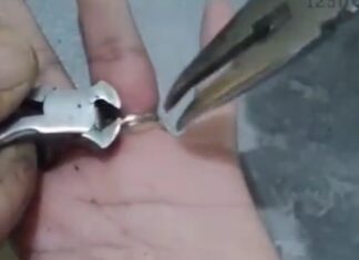 הטבעות נתקעו על האצבע – מתנדבי ידידים הצליחו להסיר שחרור טבעת שנתקעה על אצבע שהתנפחה. צילום באדיבות ארגון ידידים